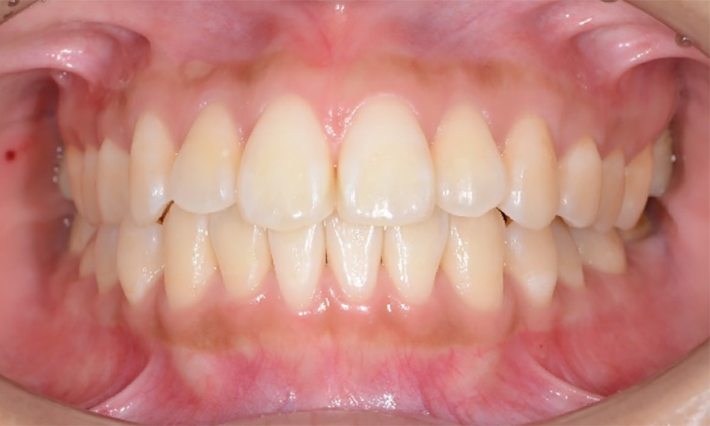 正常な歯茎の状態