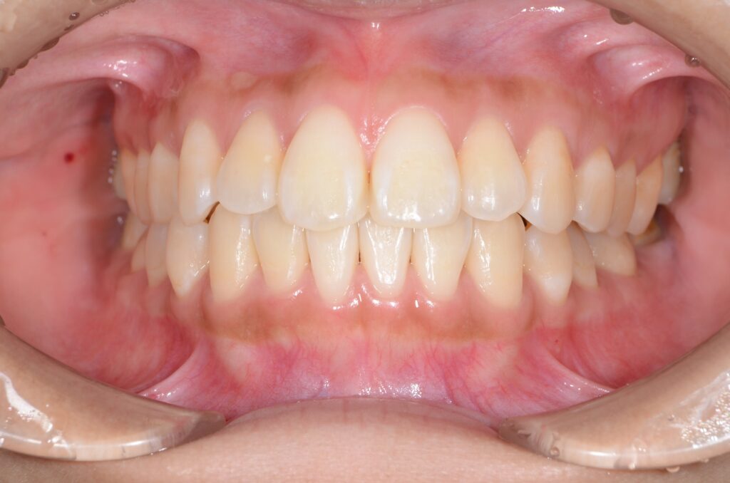 正常な歯茎